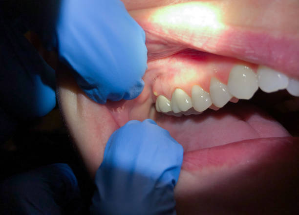 Best Tooth Infection Emergency Dentist  in Mount Pleasant, SC